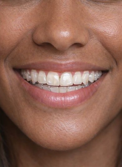 Después: Sonrisa tras tratamiento de ortodoncia invisible