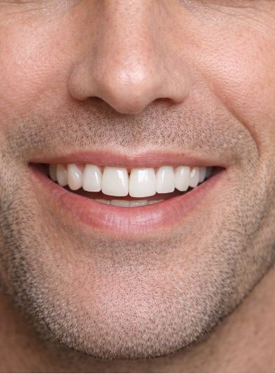 Después: Implante dental con corona cerámica