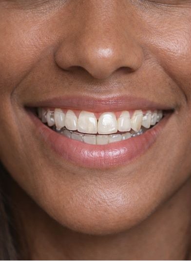 Antes: Sonrisa tras tratamiento de ortodoncia invisible