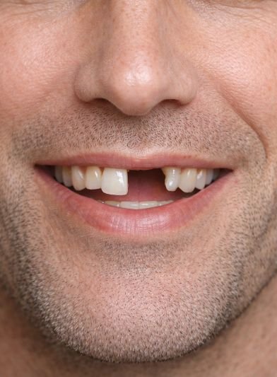 Antes: Implante dental con corona cerámica